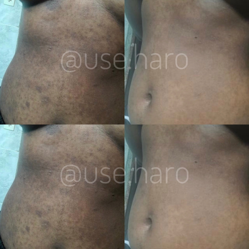 Sabonete Clareador - Pague 3 e Leve 5