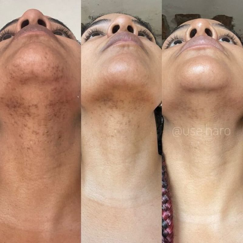 Sabonete Clareador - Pague 3 e Leve 5